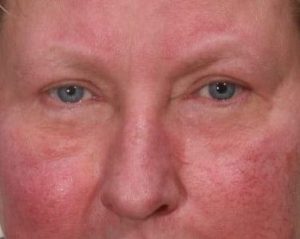 After 4 Lid Eyelid Lift