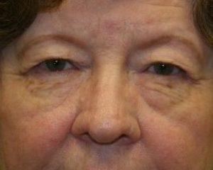 Before 4 Lid Eyelid Lift