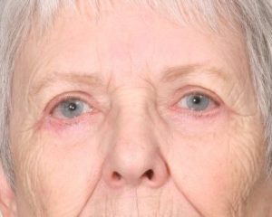 After 4 Lid Eyelid Lift