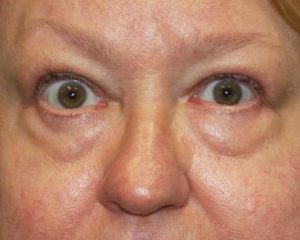 Before 4 Lid Eyelid Lift