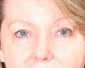 Before 4 Lid Eyelid Lift