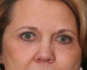 After 4 Lid Eyelid Lift
