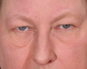 Before 4 Lid Eyelid Lift