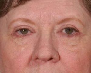 After 4 Lid Eyelid Lift