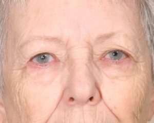 Before 4 Lid Eyelid Lift