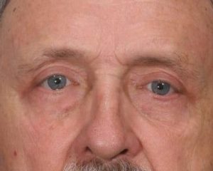 After 4 Lid Eyelid Lift