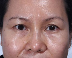 Before Upper Lid Lift