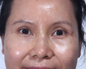 After Upper Lid Lift