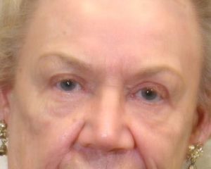 After Upper Lid Lift