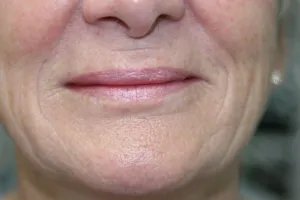 After Lip Injection