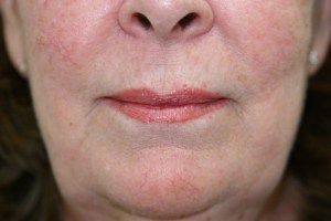 After Lip Injection