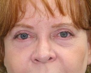 After 4 Lid Eyelid Lift