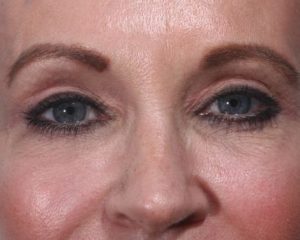 After 4 Lid Eyelid Lift