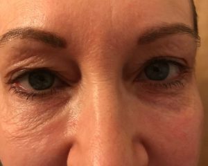 Before 4 Lid Eyelid Lift