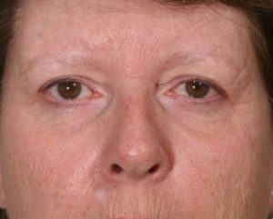 Before Upper Lid Lift