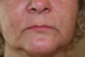 Before Lip Injection