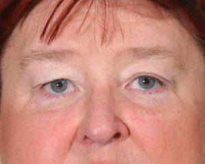 Before Upper Lid Lift
