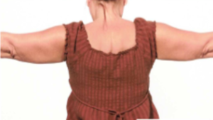 After first treatment Mesolipotherapy 