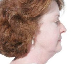 Before Mesolipotherapy 