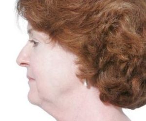 Before Mesolipotherapy 