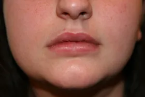 After Lip Injection