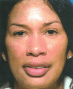 After Obagi Peel