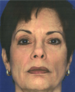 After Obagi Peel