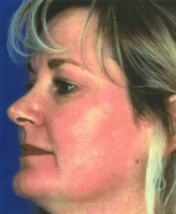 After Obagi Peel