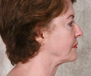 After Mesolipotherapy 