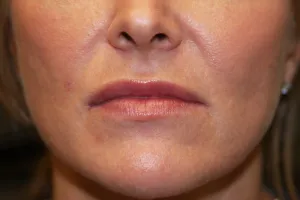 After Lip Injection