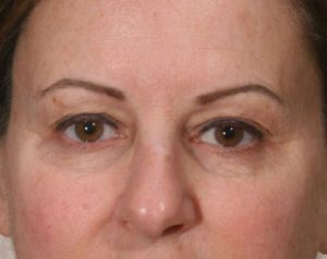 Before Upper Lid Lift