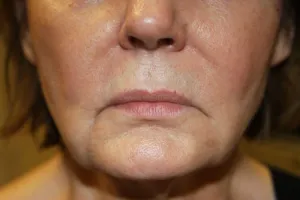 After Lip Injection