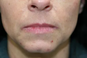 Before Lip Injection