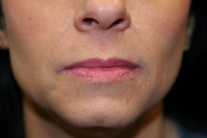 After Lip Injection