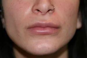 After Lip Injection