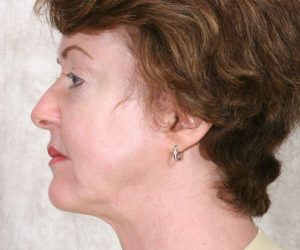 After Mesolipotherapy 