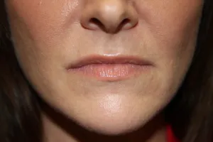Before Lip Injection
