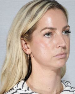 Before Bellafill treatment