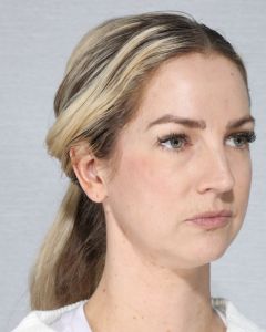 After Bellafill treatment