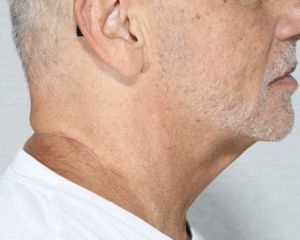 Facials, Cosmetic Peels