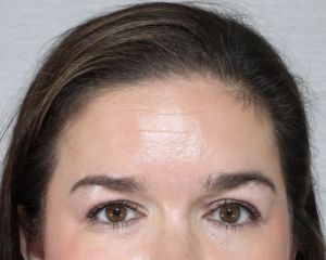 Facials, Cosmetic Peels