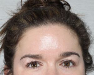 Facials, Cosmetic Peels