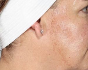 Facials, Cosmetic Peels