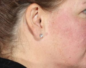 Facials, Cosmetic Peels