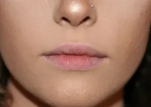 Before Lip fillers