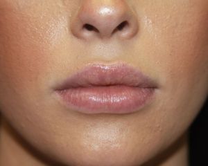After Lip Fillers