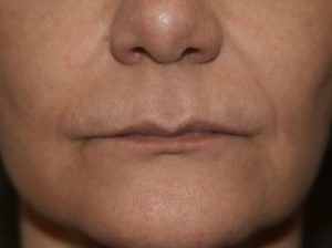 Before Lip fillers