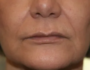 After Lip Fillers