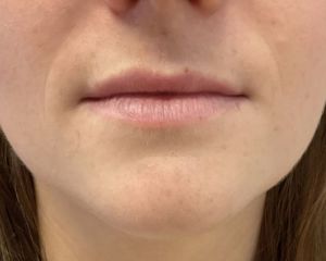 Before Lip fillers