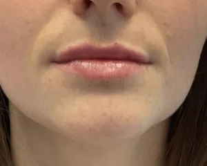 After Lip Fillers